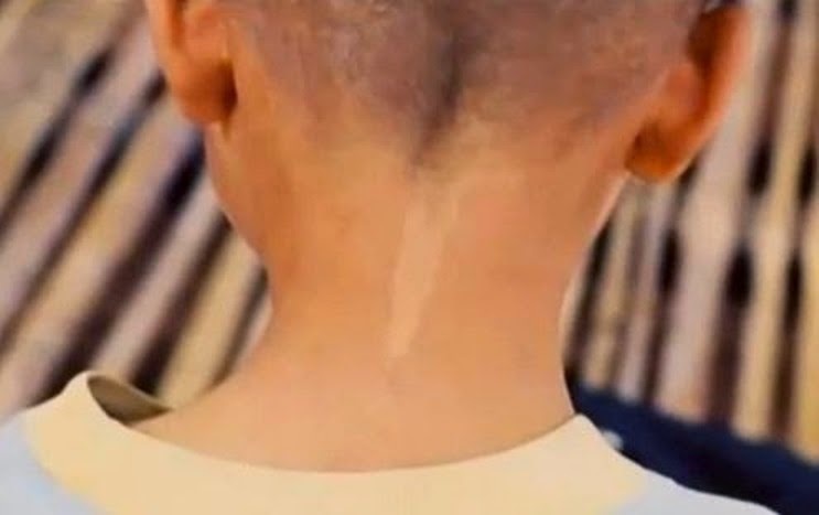 Vết bớt trên gáy của cậu bé người Thái giống hệt với vết bột trắng của bà ngoại cậu (Ảnh: Youtube)
