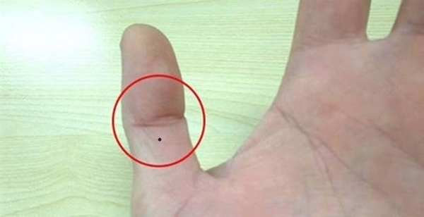 Nốt ruồi ở ngón cái