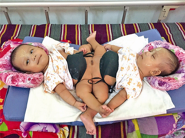 Xót xa hình ảnh cặp song sinh dính liền tại Bệnh viện Trẻ em Mandalay.