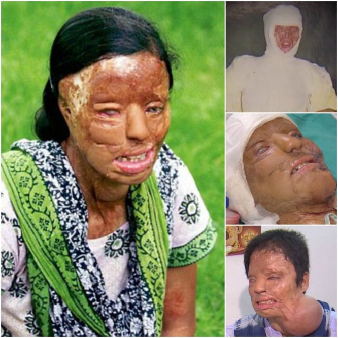 Cô gái Ấn Độ bị tạt axit gần mù mắt, phải phẫu thuật 27 lần sau 14 năm giờ ra sao?4