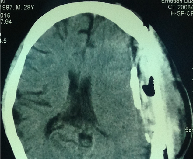 Hình ảnh CT sọ não cho thấy có ổ giảm tỷ trọng không đồng đều ngay dưới da đầu vùng tổn thương