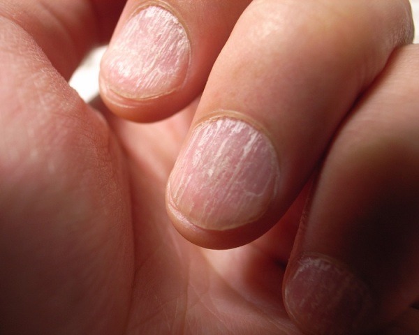 cracked-nails