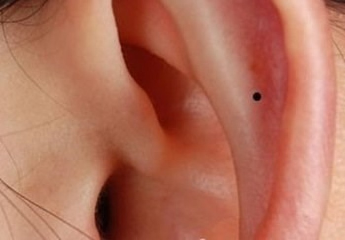 Nốt ruồi ở vành tai