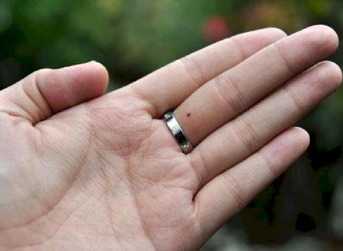 Nốt ruồi trên ngón tay