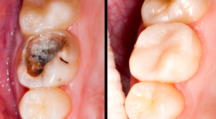 reverse-cavities-FI-759x419
