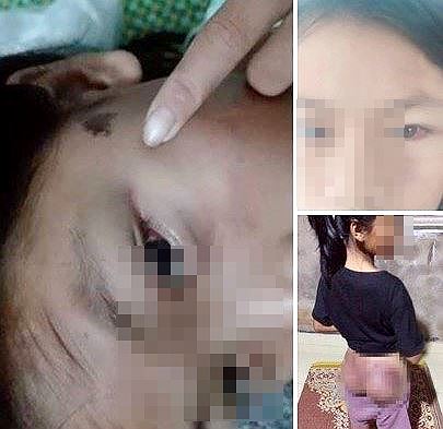 Hà Tĩnh: Bé gái 12 tuổi bị công an đánh bầm tím mông vì trộm 50.000 đồng.3