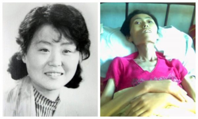 Hình ảnh cô Wei Fengju trước và sau khi bị tra tấm và tiêm thuốc. (Ảnh: Minghui.org)
