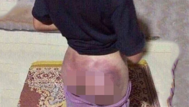 Bé gái 12 tuổi bị công an đánh bầm tím mông vì trộm 50.000 đồng. (Ảnh qua thanhnien)