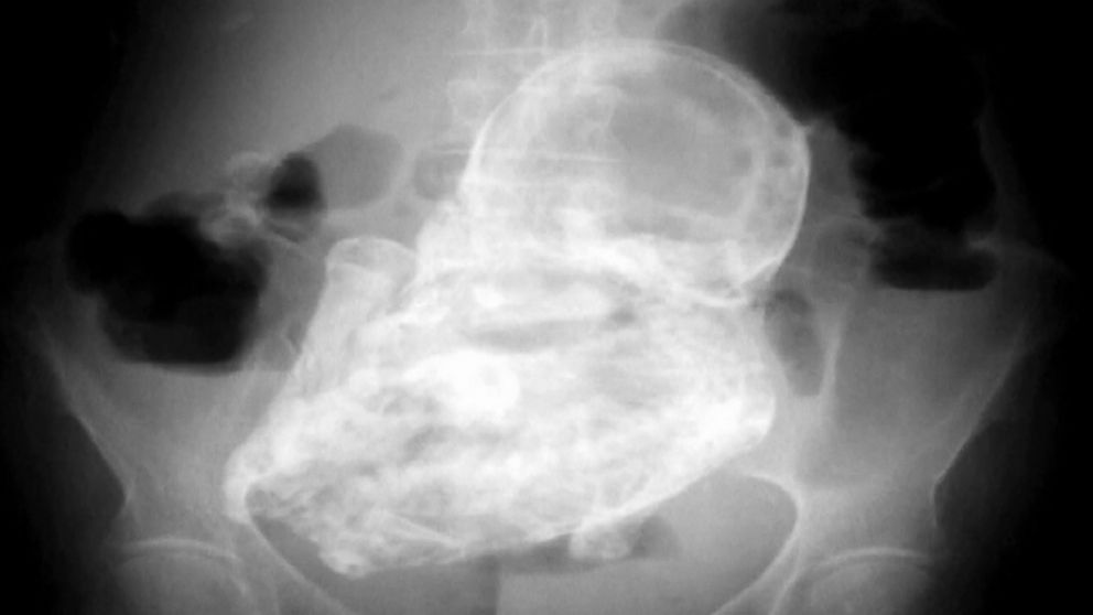 Phim chụp X-quang cho thấy có một bào thai hóa đá trong ổ bụng cụ bà 92 tuổi, bên ngoài tử cung. (Ảnh: Newsoxy)