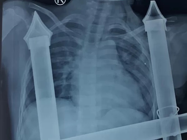 Phim chụp X-quang cho thấy thanh sắt đâm xuyên dọc thành ngực trái bệnh nhi. (Ảnh qua vnexpress)