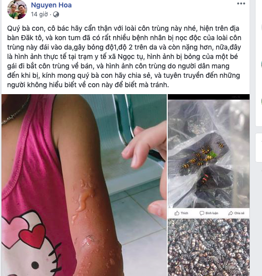 Một bé gái bị bỏng rát cánh tay do bắt bọ 3 sọc.