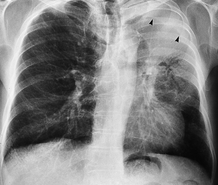 Ảnh chụp X-quang của một bệnh nhân bị xẹp phổi.
