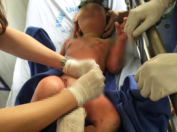 Một cháu bé bị bỏng nặng được các bác sĩ cấp cứu tại Bệnh viện đa khoa tỉnh Hà Nam