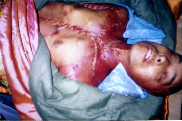 Thi thể anh Vương Bân, một người tu luyện Pháp Luân Công bị tra tấn và mổ cướp nội tạng vào ngày 24/9/2000. (Ảnh qua Flabber)