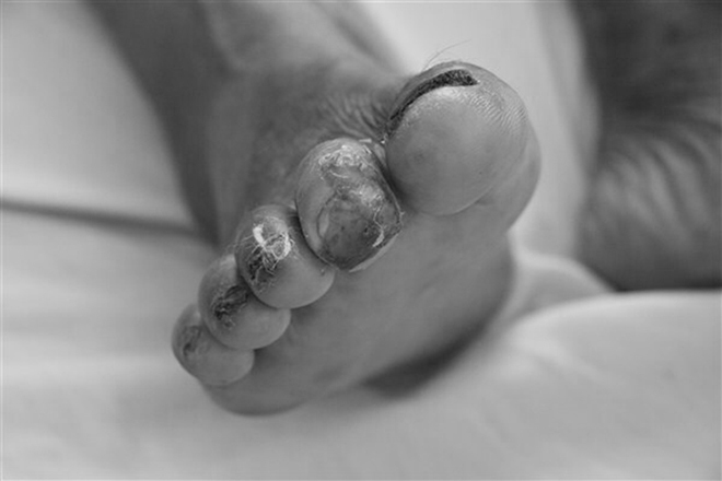 Ngón chân bị loét của một bệnh nhân là vị trí để vi khuẩn Whitmore xâm nhập vào cơ thể. (Ảnh qua vnexpress)
