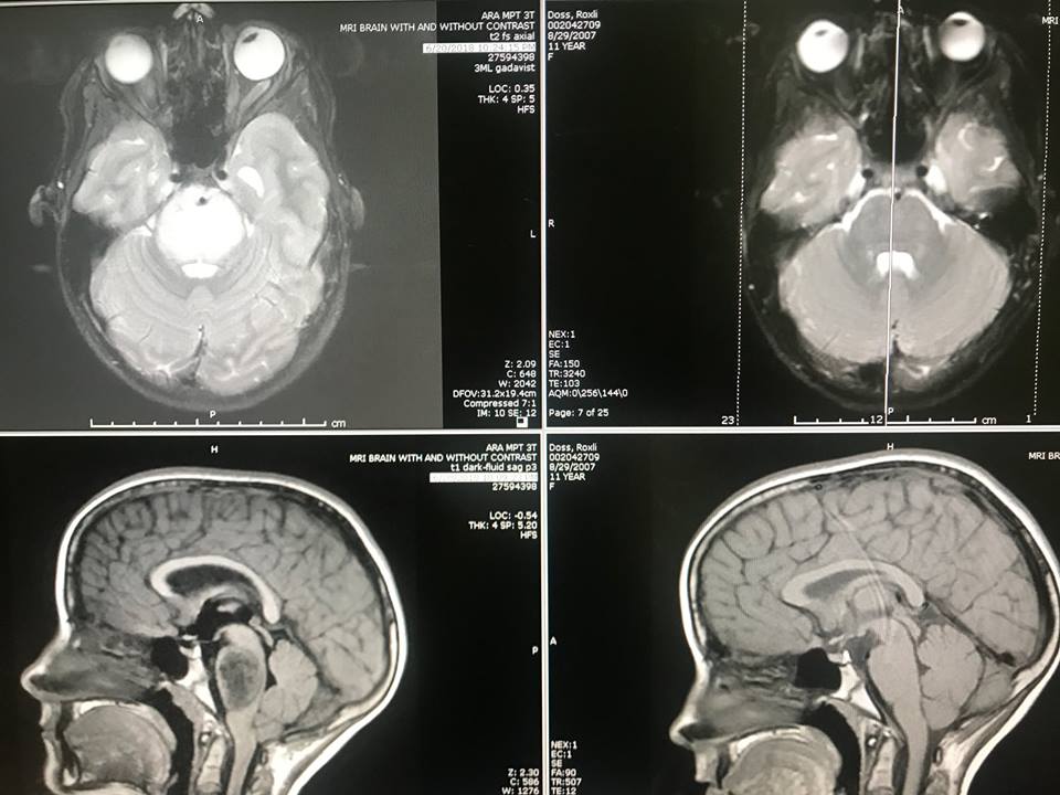 Nhờ phép màu của Chúa, khối u não trong đầu cô bé 11 tuổi đột nhiên biến mất