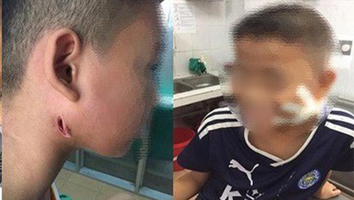 Hai trong số 3 trẻ được phát hiện mắc bệnh Whitmore tại Nghệ An. (Ảnh qua vtv)