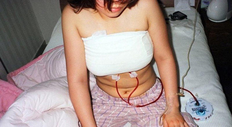 Hình ảnh một phụ nữ sau cuộc phẫu thuật nâng ngực. 