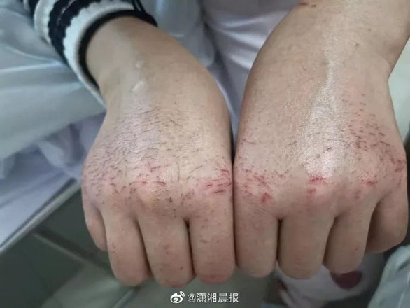 Hai bàn tay nứt nẻ, sưng lên vì làm việc liên tục của một y tá ở Vũ Hán - Ảnh: Weibo