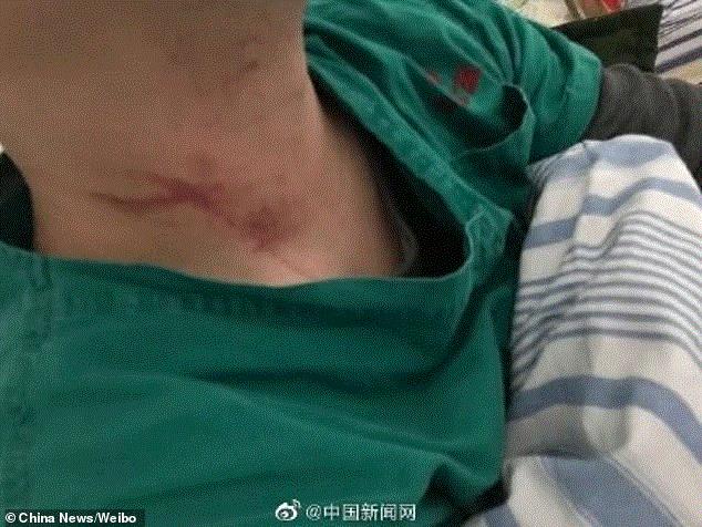 Vết thương trên cổ bác sỹ sau khi bị hành hung. (Ảnh: China News)