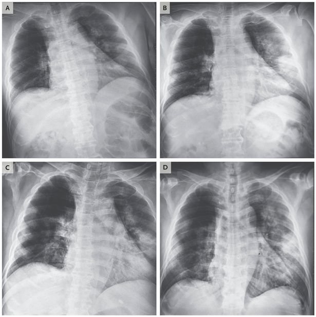 X-quang ngực của một người đàn ông Việt Nam được chẩn đoán sau khi đi Vũ Hán (Ảnh: Twitter)