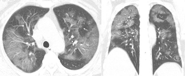 Một phụ nữ 54 tuổi bị viêm phổi nặng Covid-19 sau khi đến Vũ Hán (Ảnh: RSNA)