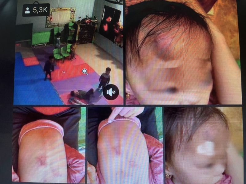 Hình ảnh bé gái bị thương tích. (Ảnh: cand.com.vn)